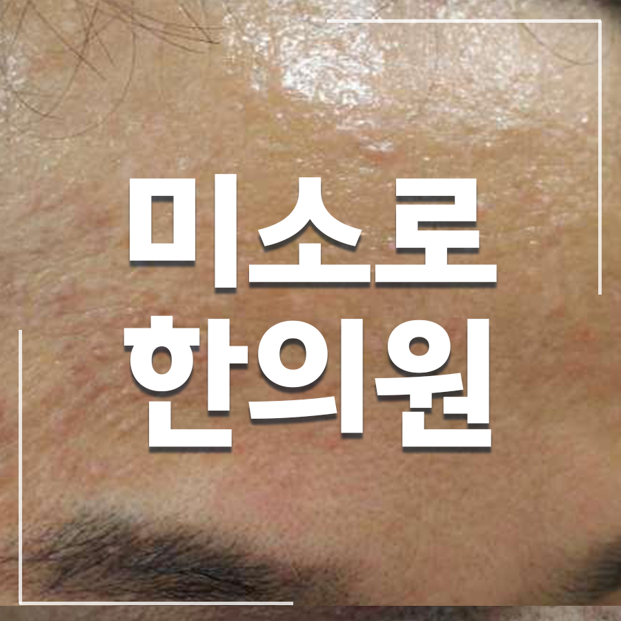 위례 바르는 평편사마귀 연고 관련 이미지 1
