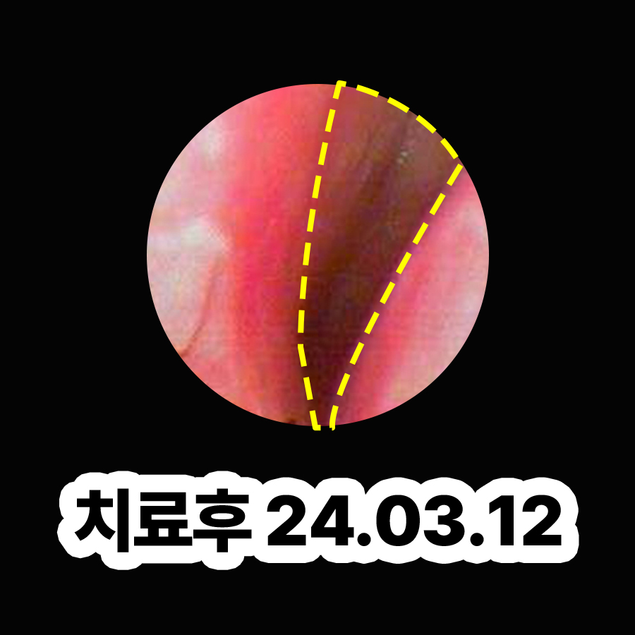분당 비염 이비인후과 관련 이미지 3