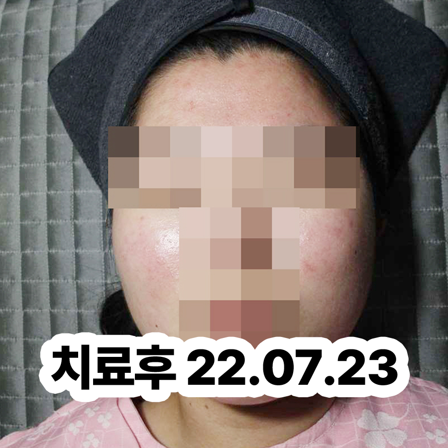 여주 지루성 피부염 피부과 명의 관련 이미지 3