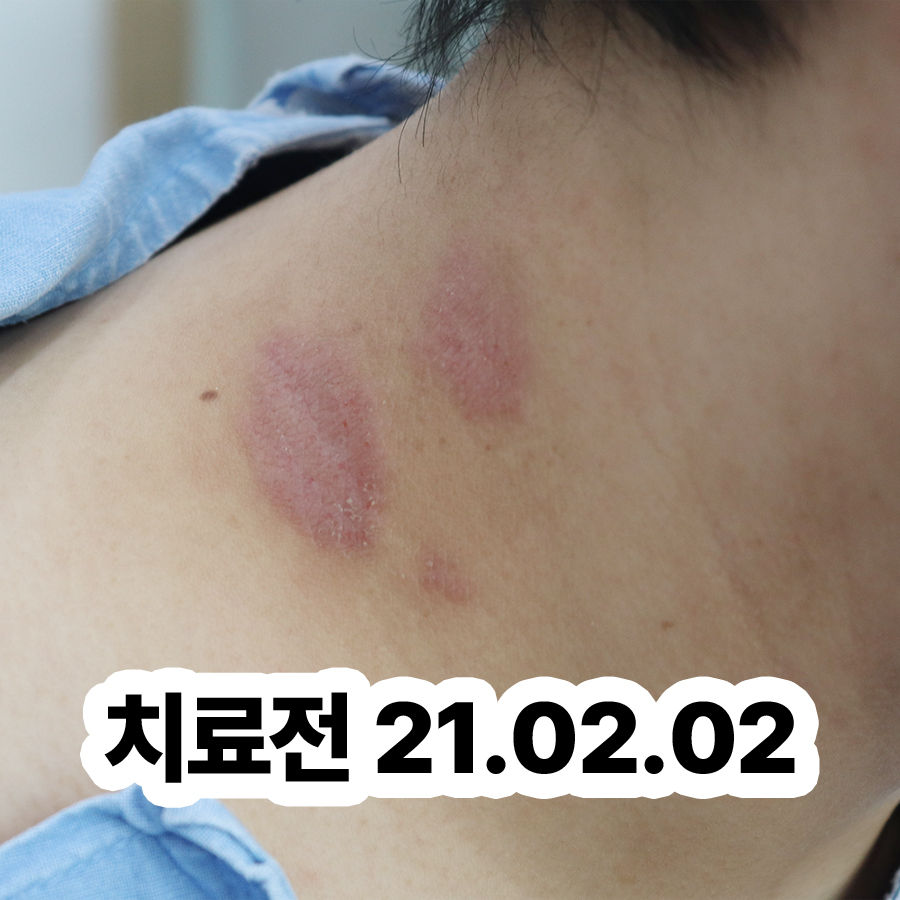 분당 아토피 한방치료 효과 관련 이미지 2