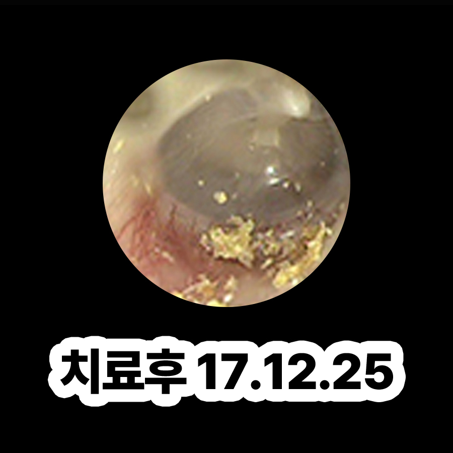 분당 중이염 수술 후유증 관련 이미지 3