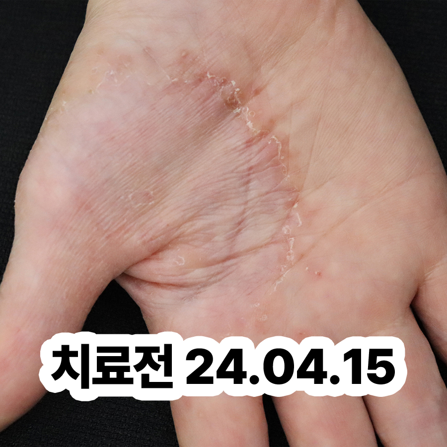 분당 한포진보습제 관련 이미지 2