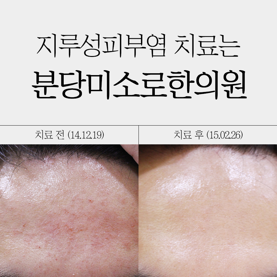 분당 지루성피부염 치료 관련 이미지 1