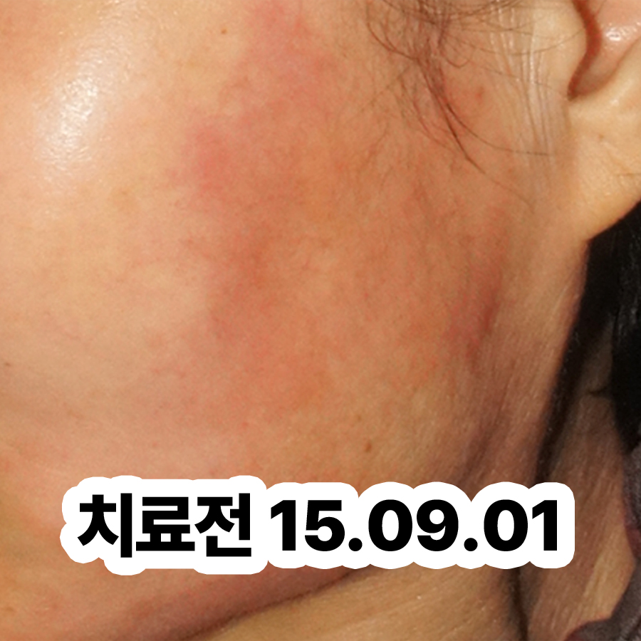 분당 지루성피부염 한의원 관련 이미지 2