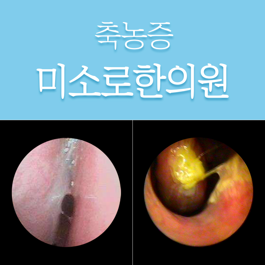 용인 축농증내시경수술비용 관련 이미지 1