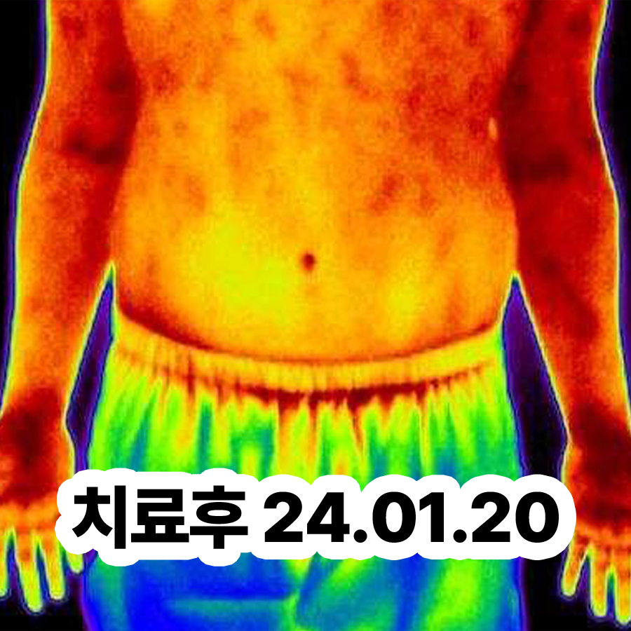 분당 손 다한증 치료 병원 관련 이미지 3
