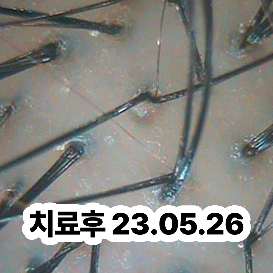 성남 머리 지루성 피부염 연고 관련 이미지 3