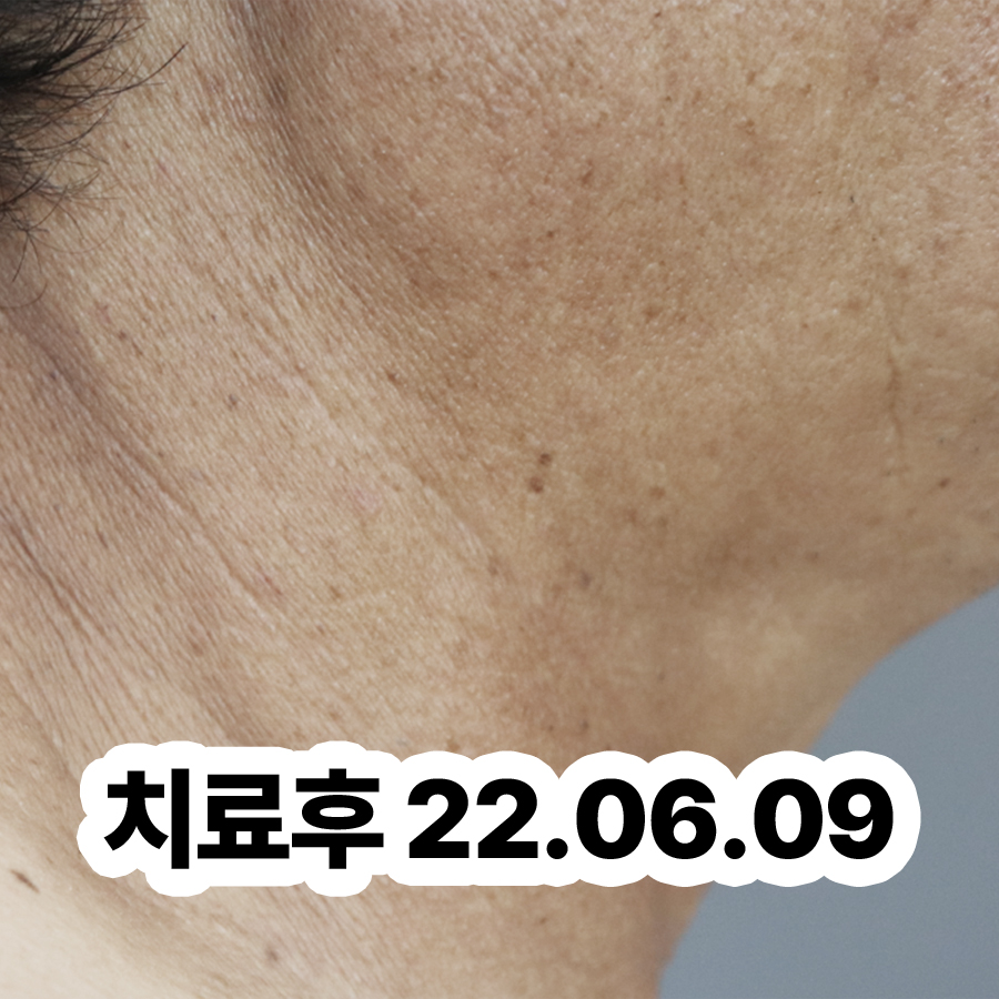 경기광주 사타구니 습진 병원 추천 관련 이미지 3
