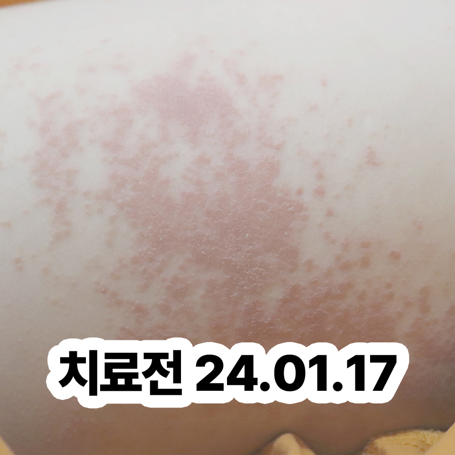 경기광주 얼굴 지루성 피부염 치료 관련 이미지 2