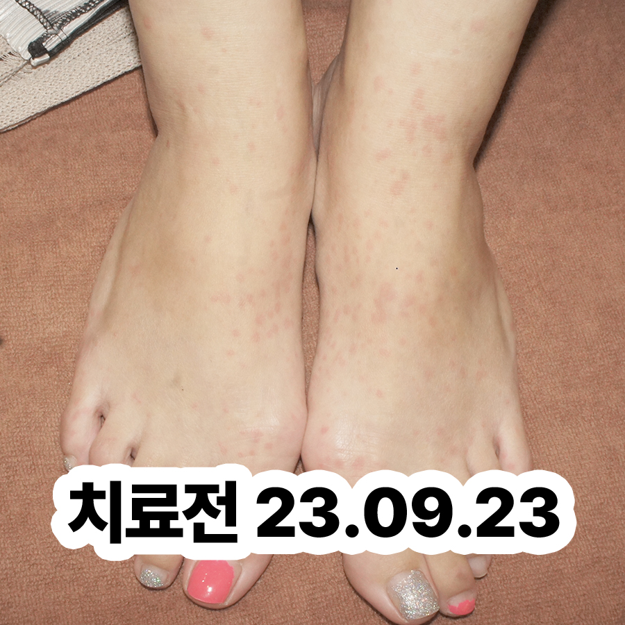 이천 피부묘기증 치료 관련 이미지 2
