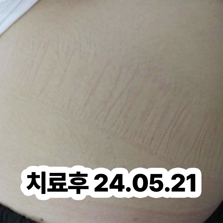 분당 두드러기치료방법 관련 이미지 3
