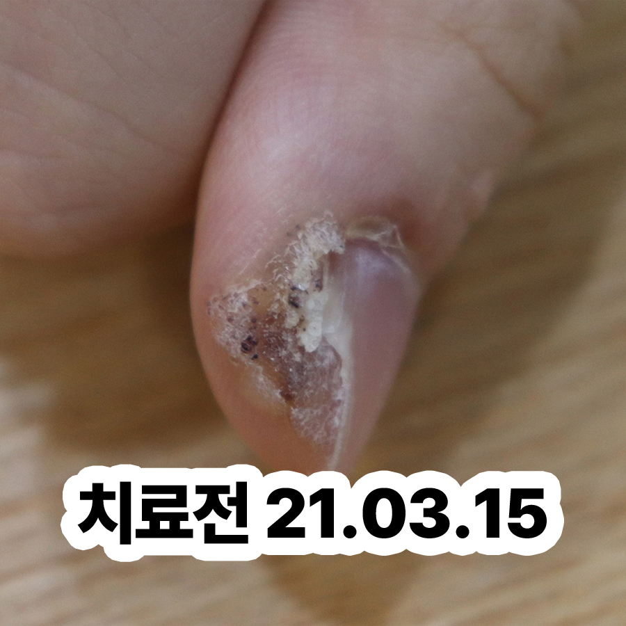 분당 발가락 사마귀 치료 방법 관련 이미지 2