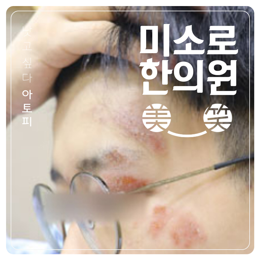 논산 아토피 한약 실비