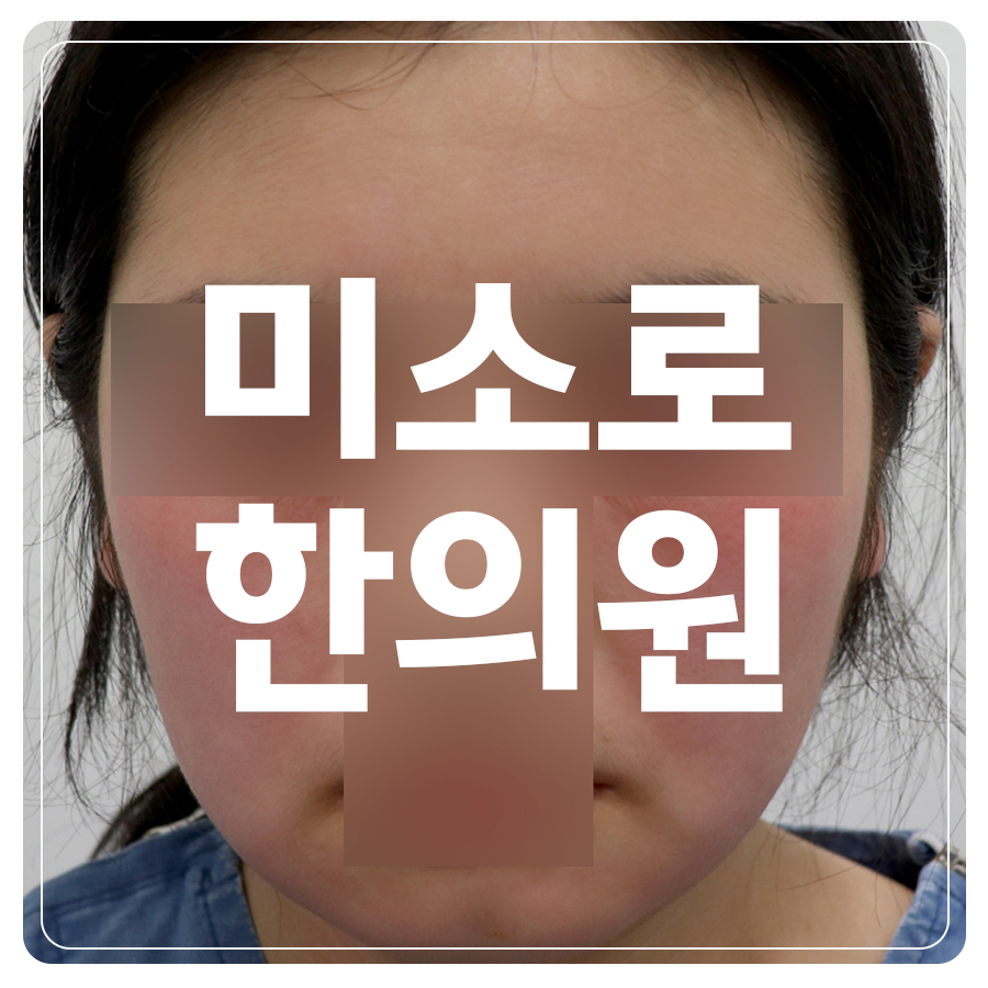송천동 허벅지 습진 이유 관련 이미지 1
