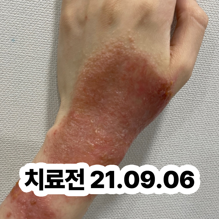 경기광주 발한포진연고 관련 이미지 2