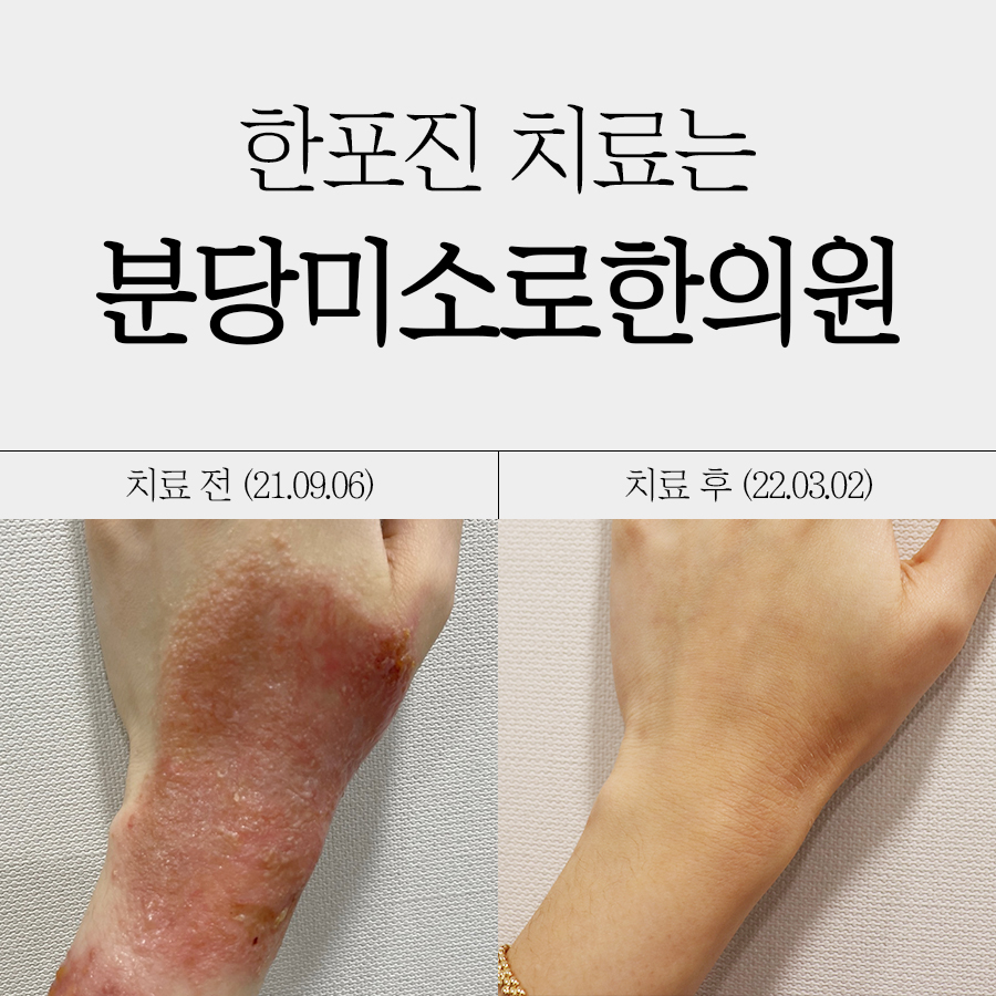 위례 손 한포진 치료 관련 이미지 1