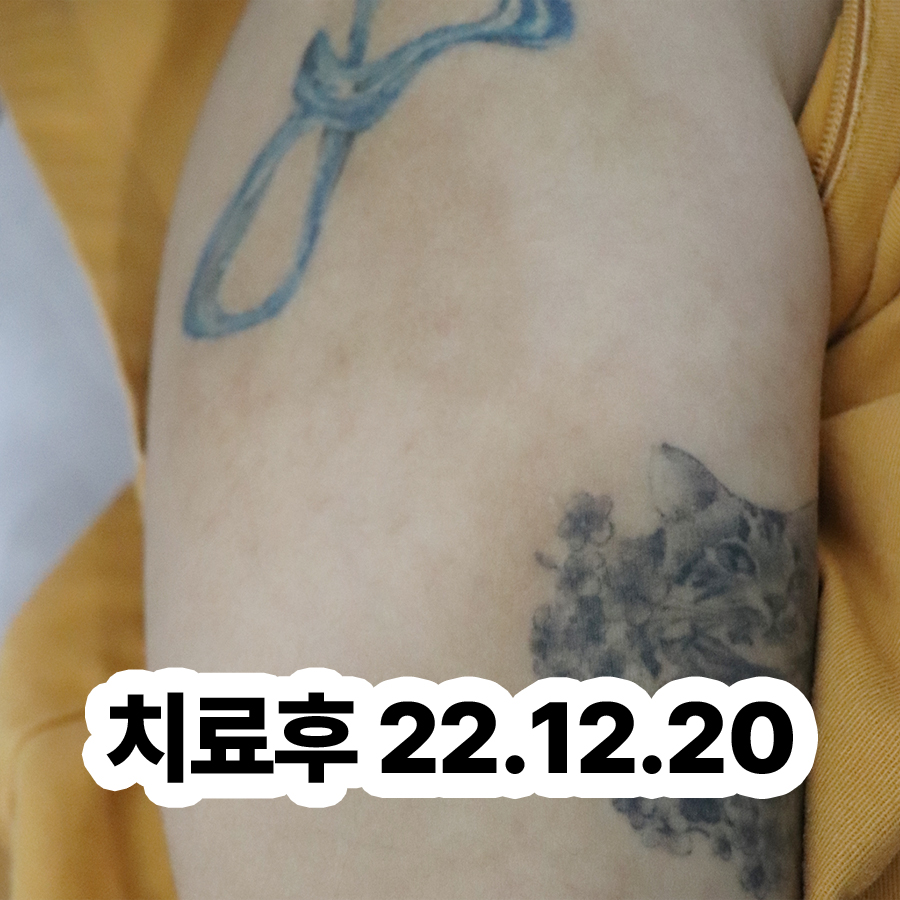 분당 건성 습진 증상 관련 이미지 3