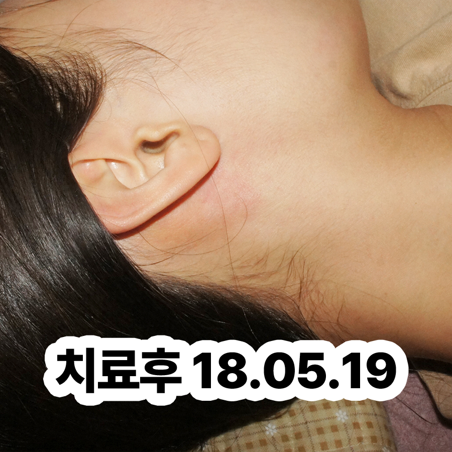 분당 건선피부치료 관련 이미지 3