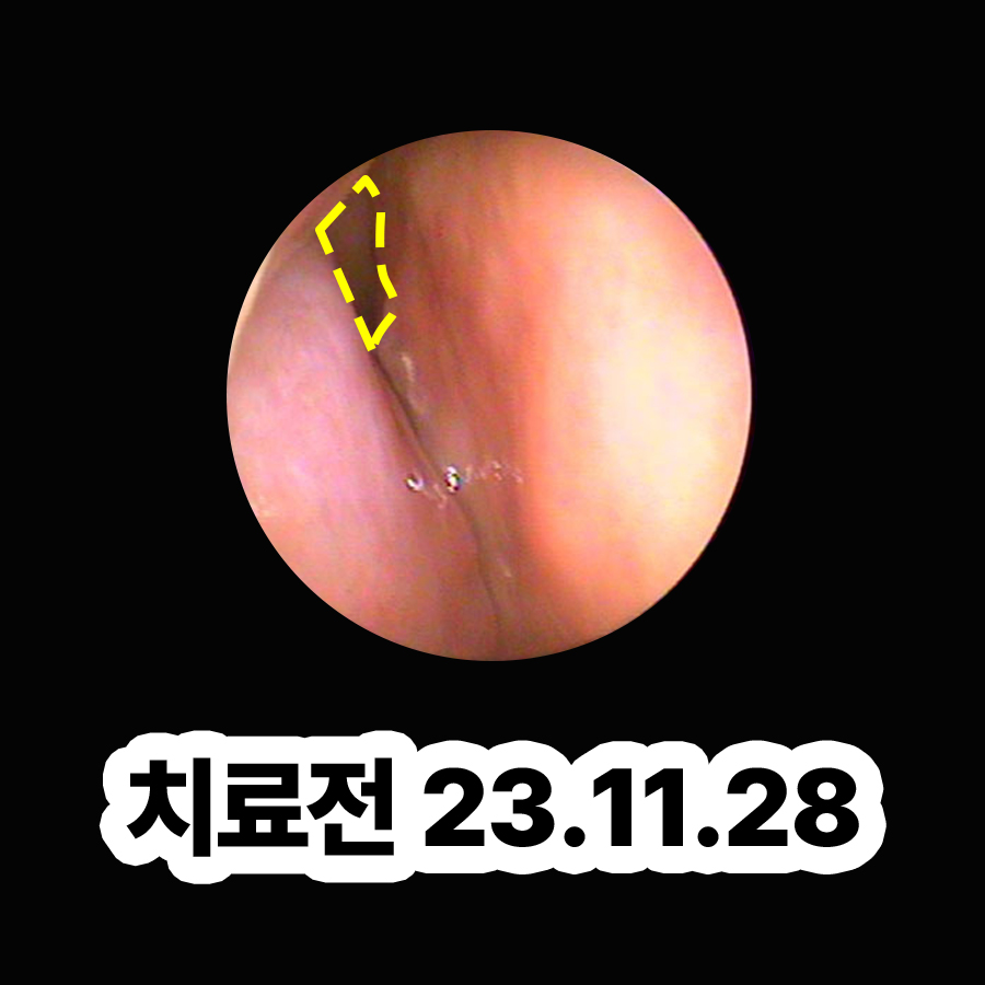 이천 비염치료비용 관련 이미지 2