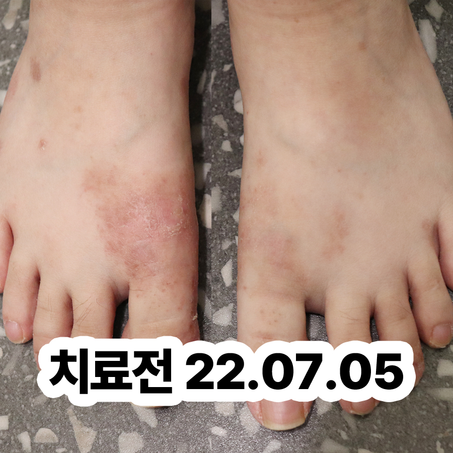분당 손가락 한포진 연고 리도맥스 관련 이미지 2