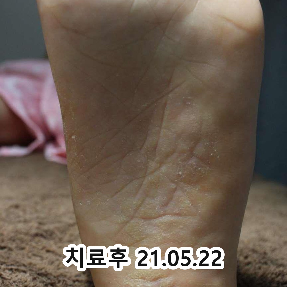 판교 사타구니 습진 병원 어디로 관련 이미지 3