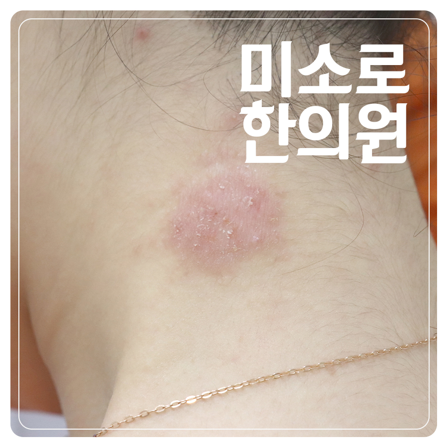 분당 아토피 피부염 증상 관련 이미지 1