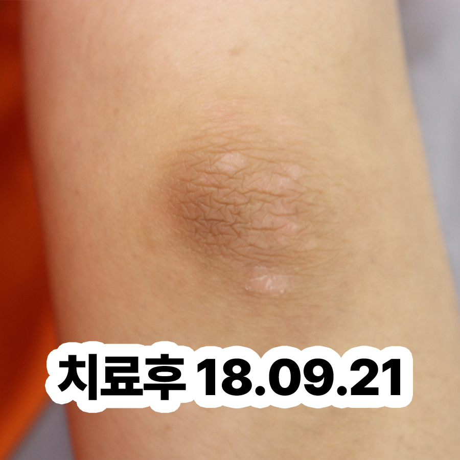 분당 건선 피부과 관련 이미지 3