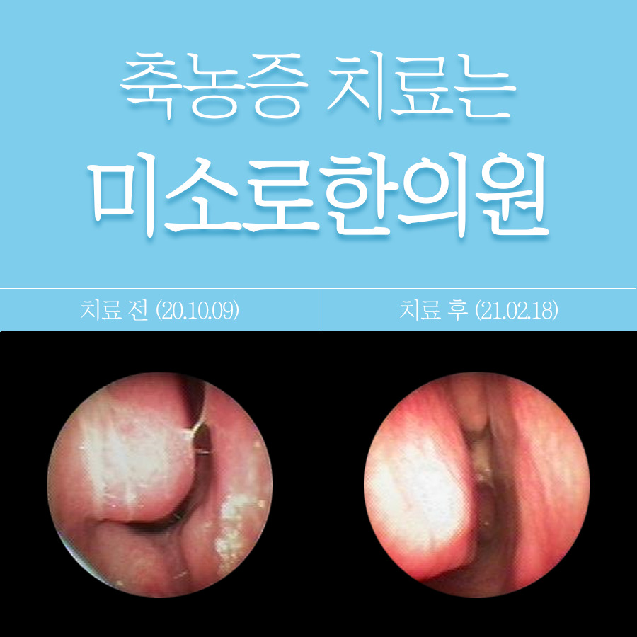 여주 축농증 내시경 수술비용 관련 이미지 1