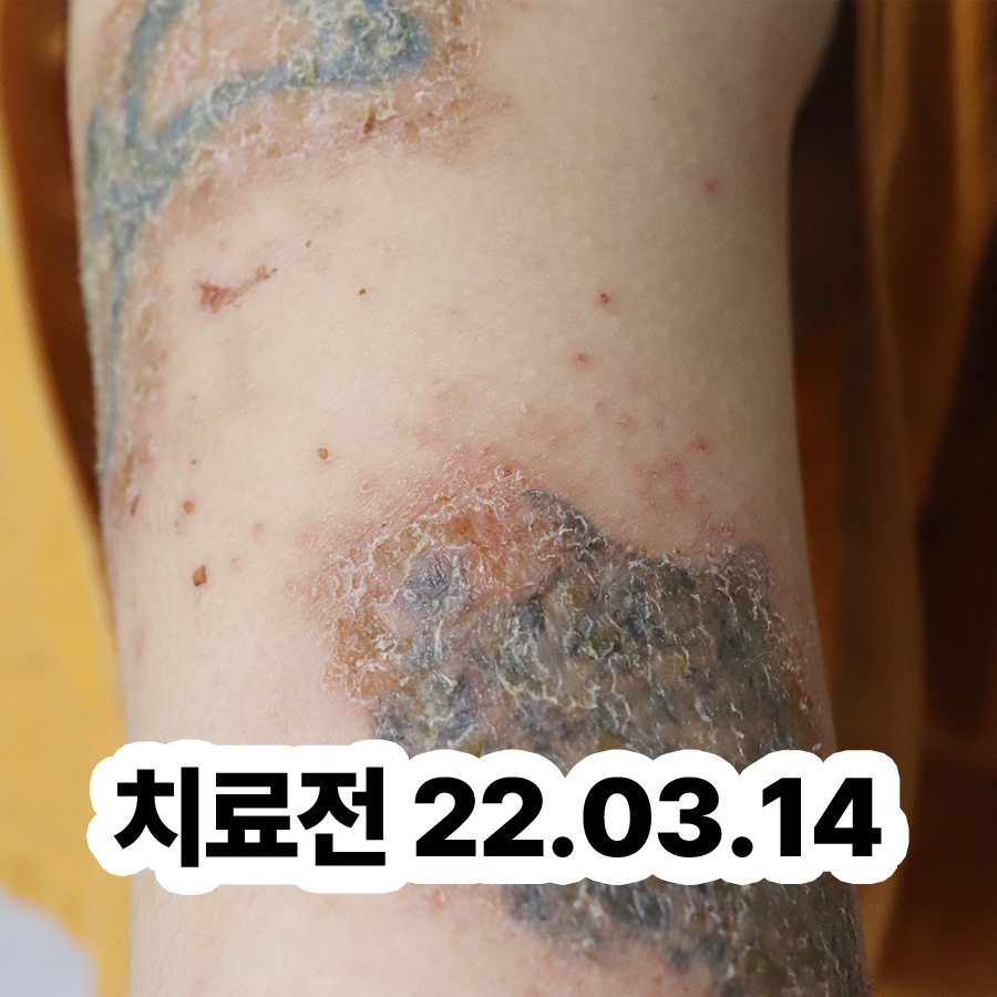 분당 건성 습진 증상 관련 이미지 2